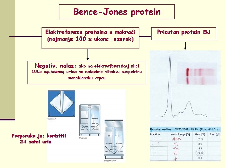 Bence-Jones protein Elektroforeza proteina u mokraći (najmanje 100 x ukonc. uzorak) Negativ. nalaz: ako