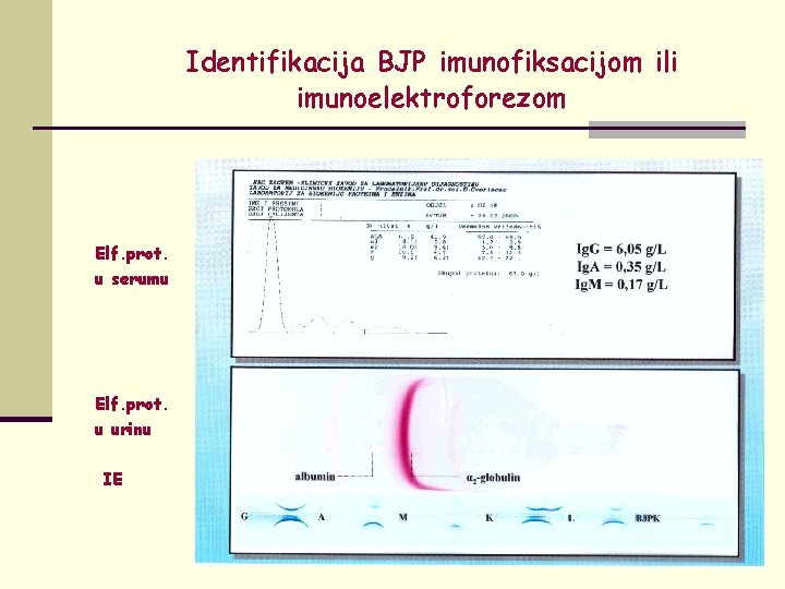 Identifikacija BJP imunofiksacijom ili imunoelektroforezom Elf. prot. u serumu Elf. prot. u urinu IE