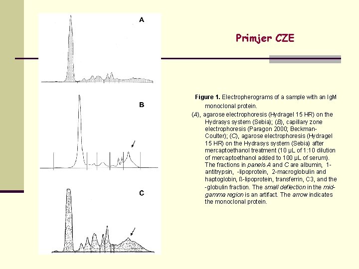 Primjer CZE Figure 1. Electropherograms of a sample with an Ig. M monoclonal protein.