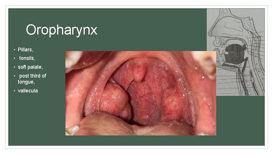 Oropharynx • Pillars, • tonsils, • soft palate, • post third of tongue, •