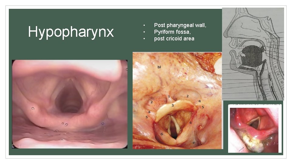 Hypopharynx • • • Post pharyngeal wall, Pyriform fossa, post cricoid area 
