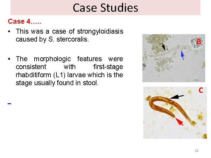 Case Studies Case 4…. . • This was a case of strongyloidiasis caused by