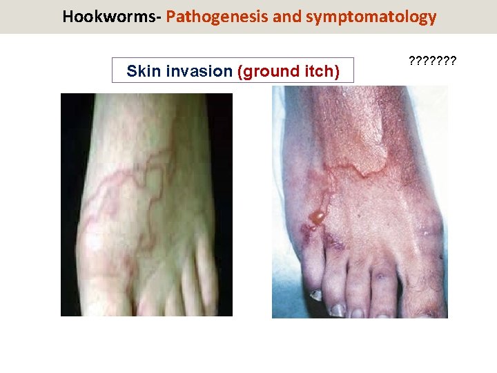 Hookworms- Pathogenesis and symptomatology Skin invasion (ground itch) ? ? ? ? 