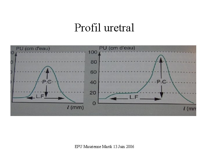 Profil uretral EPU Maurienne Mardi 13 Juin 2006 