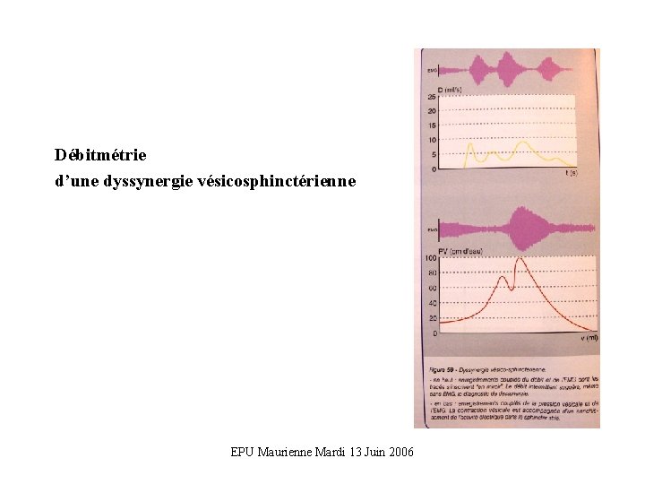 Débitmétrie d’une dyssynergie vésicosphinctérienne EPU Maurienne Mardi 13 Juin 2006 