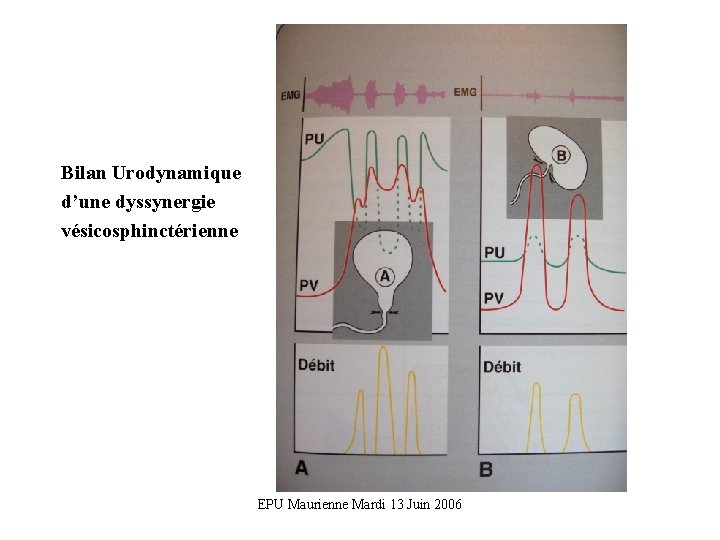 Bilan Urodynamique d’une dyssynergie vésicosphinctérienne EPU Maurienne Mardi 13 Juin 2006 