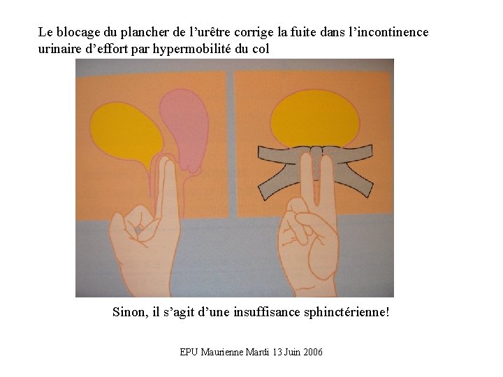 Le blocage du plancher de l’urêtre corrige la fuite dans l’incontinence urinaire d’effort par