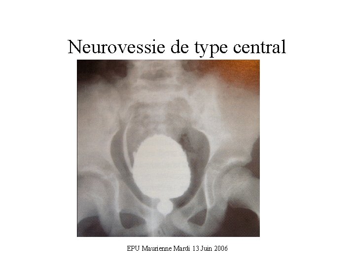 Neurovessie de type central EPU Maurienne Mardi 13 Juin 2006 