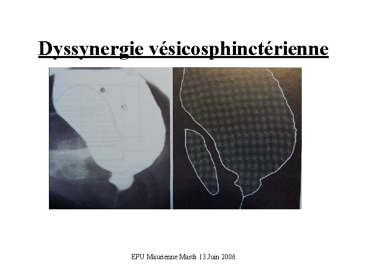 Dyssynergie vésicosphinctérienne EPU Maurienne Mardi 13 Juin 2006 