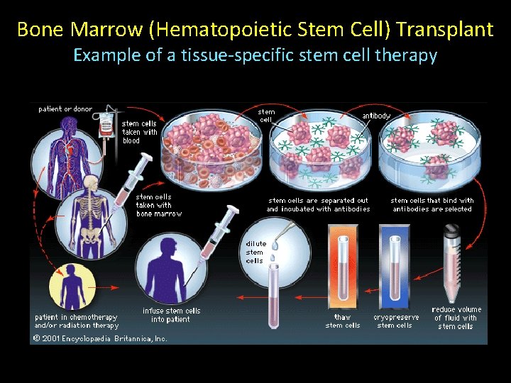 Bone Marrow (Hematopoietic Stem Cell) Transplant Example of a tissue-specific stem cell therapy 