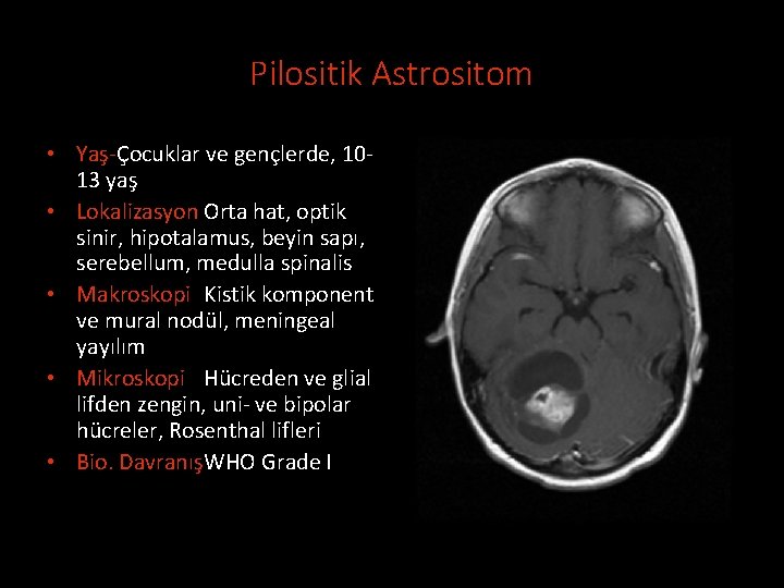 Pilositik Astrositom • Yaş-Çocuklar ve gençlerde, 1013 yaş • Lokalizasyon Orta hat, optik sinir,