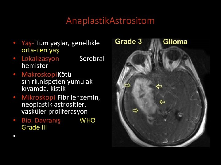 Anaplastik. Astrositom • Yaş- Tüm yaşlar, genellikle orta-ileri yaş • Lokalizasyon Serebral hemisfer •