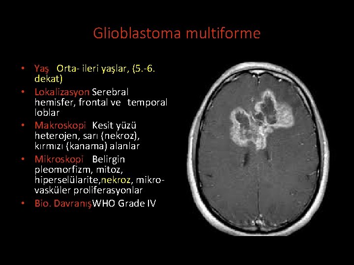 Glioblastoma multiforme • Yaş Orta- ileri yaşlar, (5. -6. dekat) • Lokalizasyon Serebral hemisfer,