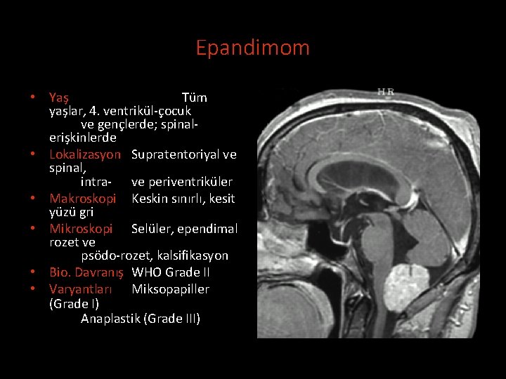 Epandimom • Yaş Tüm yaşlar, 4. ventrikül-çocuk ve gençlerde; spinalerişkinlerde • Lokalizasyon Supratentoriyal ve