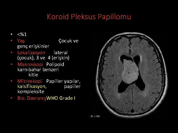 Koroid Pleksus Papillomu • <%1 • Yaş Çocuk ve genç erişkinler • Lokalizasyon lateral