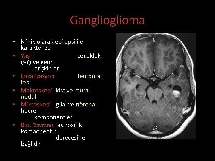 Ganglioma • Klinik olarak epilepsi ile karakterize • Yaş çocukluk çağı ve genç erişkinler