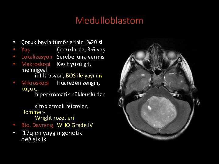 Medulloblastom Çocuk beyin tümörlerinin %20’si Yaş Çocuklarda, 3 -6 yaş Lokalizasyon Serebellum, vermis Makroskopi