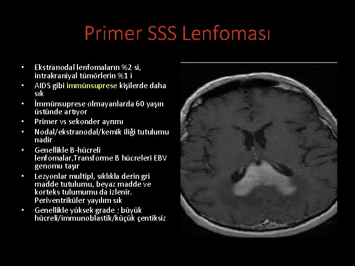 Primer SSS Lenfoması • • Ekstranodal lenfomaların %2 si, intrakraniyal tümörlerin %1 i AIDS
