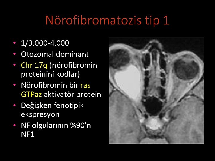 Nörofibromatozis tip 1 • 1/3. 000 -4. 000 • Otozomal dominant • Chr 17