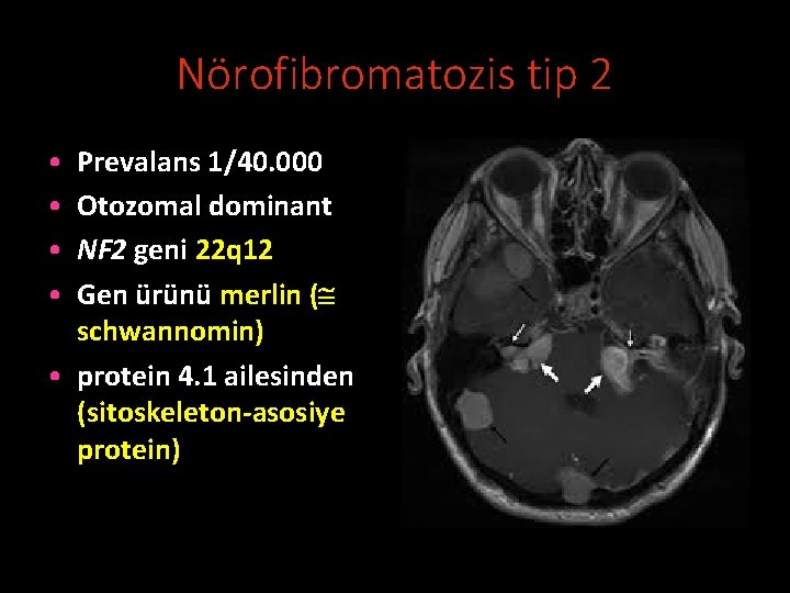 Nörofibromatozis tip 2 • • Prevalans 1/40. 000 Otozomal dominant NF 2 geni 22