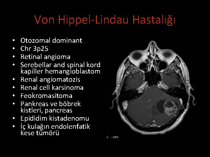 Von Hippel-Lindau Hastalığı • • • Otozomal dominant Chr 3 p 25 Retinal angioma