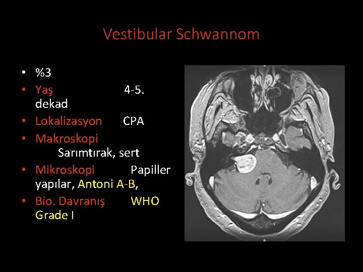 Vestibular Schwannom • %3 • Yaş 4 -5. dekad • Lokalizasyon CPA • Makroskopi