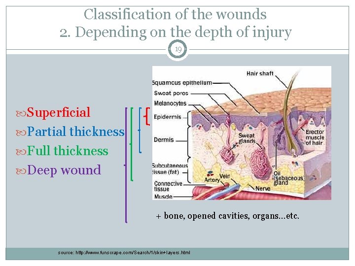 Classification of the wounds 2. Depending on the depth of injury 19 Superficial Partial