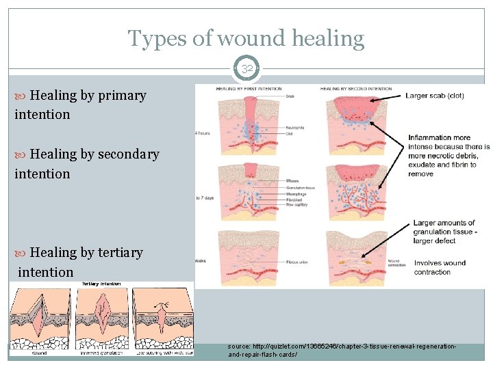 Types of wound healing 32 Healing by primary intention Healing by secondary intention Healing