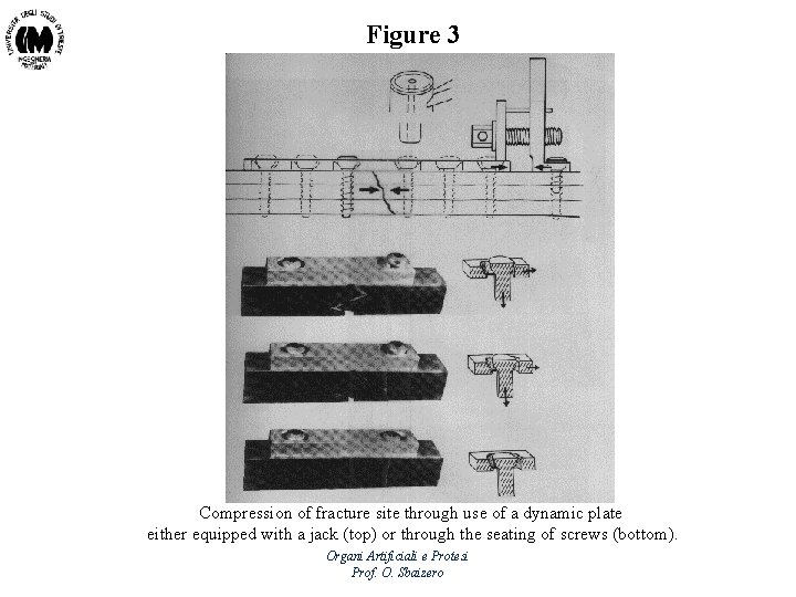 Figure 3 Compression of fracture site through use of a dynamic plate either equipped