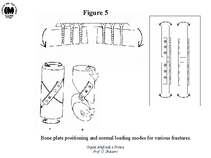 Figure 5 Bone plate positioning and normal loading modes for various fractures. Organi Artificiali