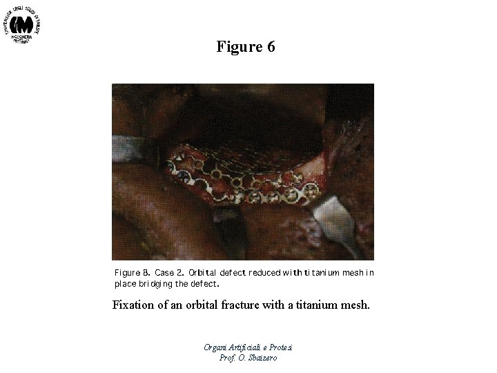 Figure 6 Fixation of an orbital fracture with a titanium mesh. Organi Artificiali e
