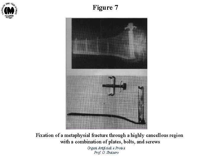 Figure 7 Fixation of a metaphysial fracture through a highly cancellous region with a