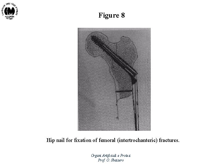 Figure 8 Hip nail for fixation of femoral (intertrochanteric) fractures. Organi Artificiali e Protesi