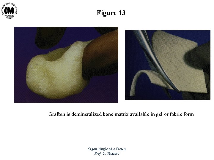 Figure 13 Grafton is demineralized bone matrix available in gel or fabric form Organi