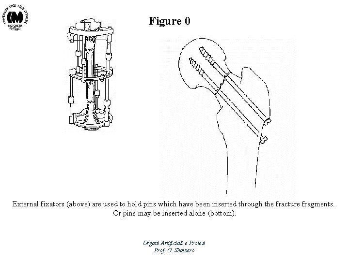 Figure 0 External fixators (above) are used to hold pins which have been inserted