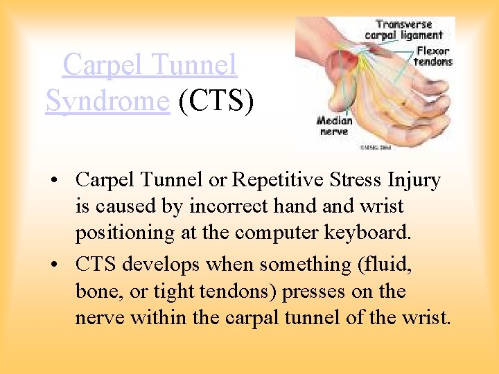 Carpel Tunnel Syndrome (CTS) • Carpel Tunnel or Repetitive Stress Injury is caused by Carpel Tunnel Syndrome (CTS) • Carpel Tunnel or Repetitive Stress Injury is caused by