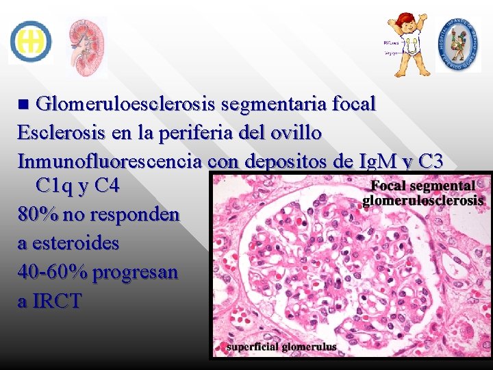 Glomeruloesclerosis segmentaria focal Esclerosis en la periferia del ovillo Inmunofluorescencia con depositos de Ig.