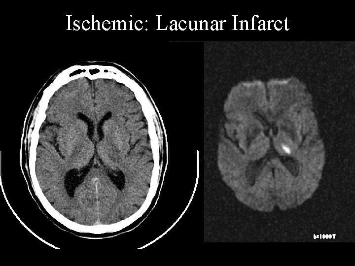 Ischemic: Lacunar Infarct 