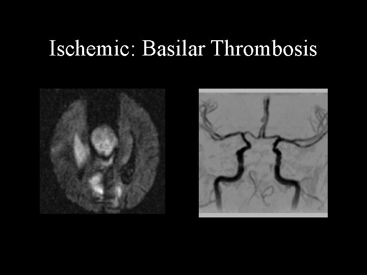 Ischemic: Basilar Thrombosis 