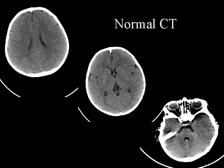 Normal CT 