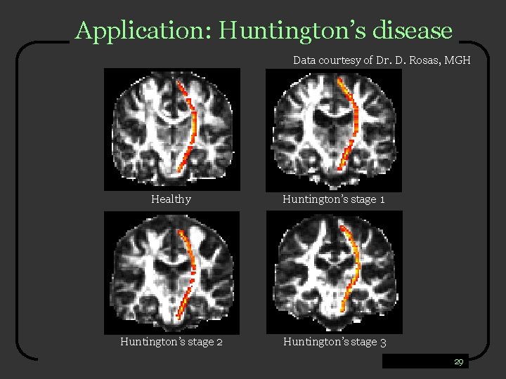 Application: Huntington’s disease Data courtesy of Dr. D. Rosas, MGH Healthy Huntington’s stage 1