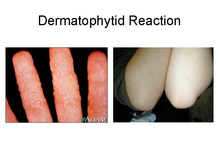 Dermatophytid Reaction Dermatophytid Reaction