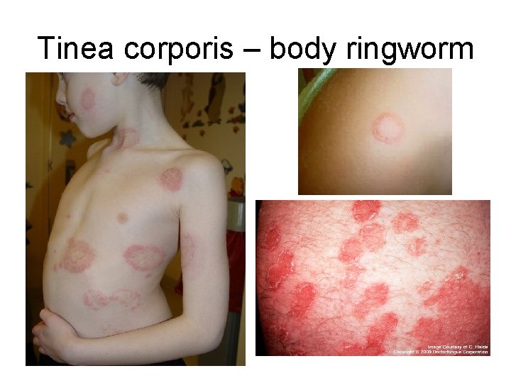 Tinea corporis – body ringworm Tinea corporis – body ringworm