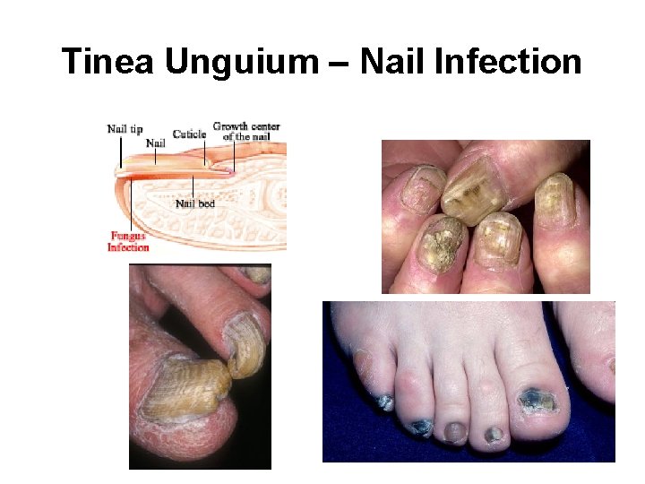 Tinea Unguium – Nail Infection Tinea Unguium – Nail Infection
