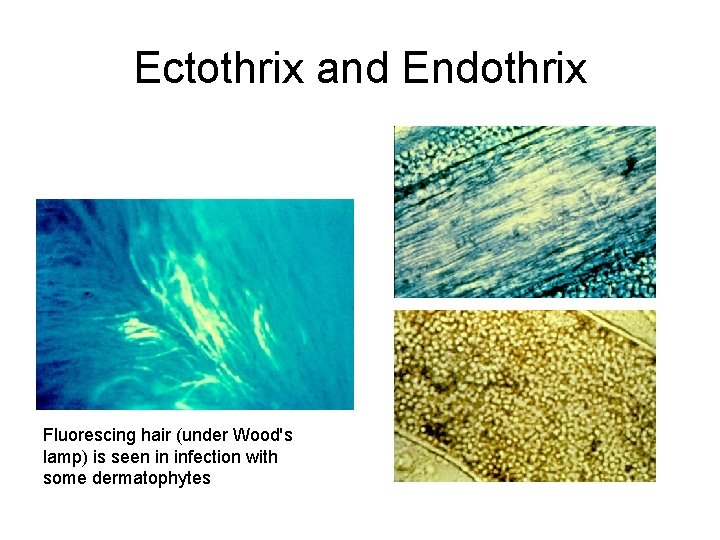 Ectothrix and Endothrix Fluorescing hair (under Wood's lamp) is seen in infection with some Ectothrix and Endothrix Fluorescing hair (under Wood's lamp) is seen in infection with some
