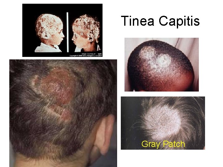 Tinea Capitis Gray Patch Tinea Capitis Gray Patch
