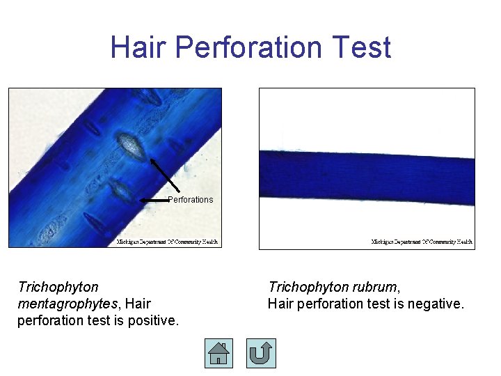 Hair Perforation Test Perforations Trichophyton mentagrophytes, Hair perforation test is positive. Trichophyton rubrum, Hair Hair Perforation Test Perforations Trichophyton mentagrophytes, Hair perforation test is positive. Trichophyton rubrum, Hair