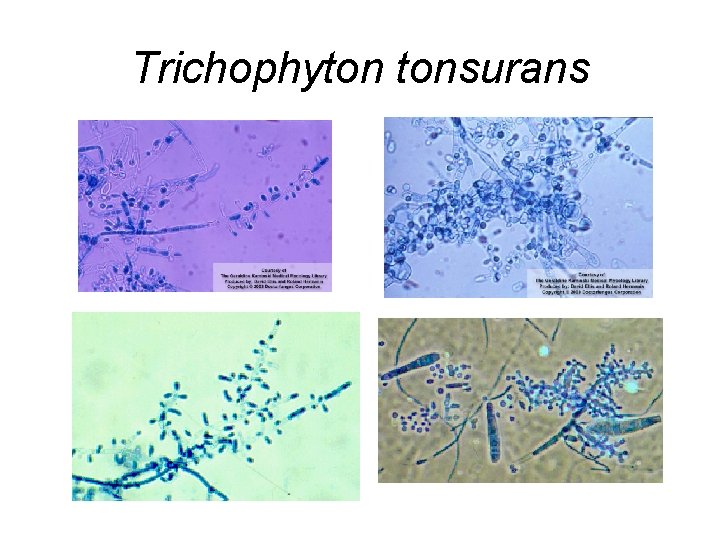 Trichophyton tonsurans Trichophyton tonsurans