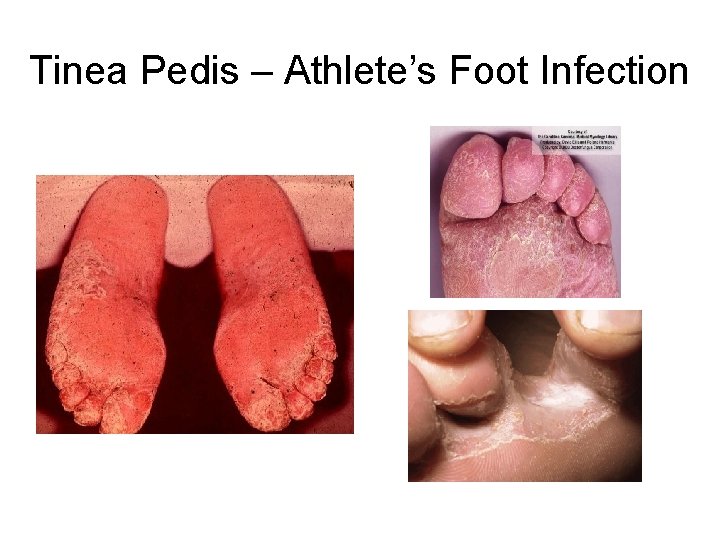 Tinea Pedis – Athlete’s Foot Infection Tinea Pedis – Athlete’s Foot Infection