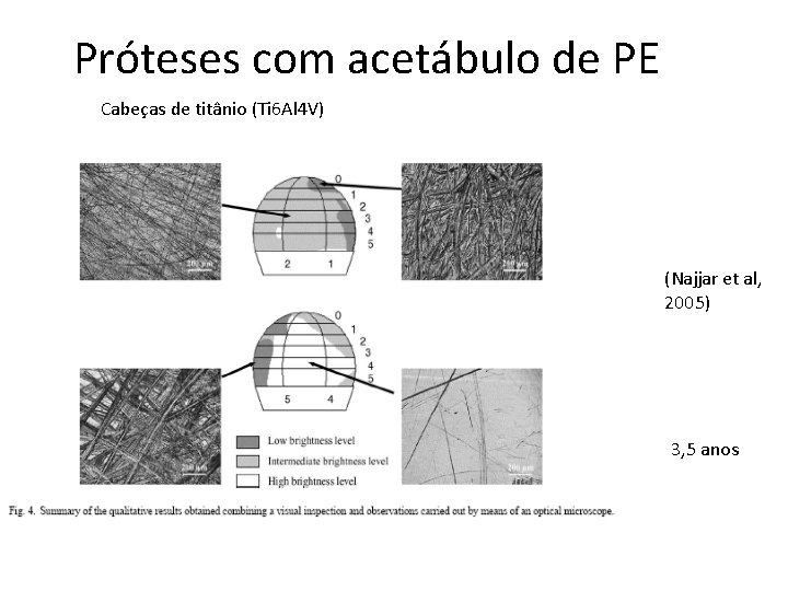 Próteses com acetábulo de PE Cabeças de titânio (Ti 6 Al 4 V) (Najjar